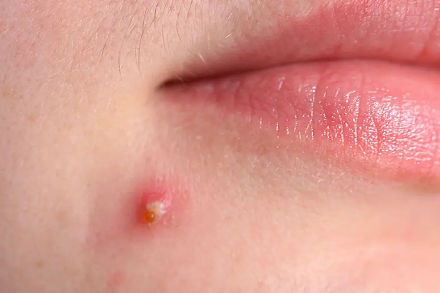 Mụn trứng cá sẽ phát triển thành mụn bọc nếu da không được chăm sóc đúng cách.