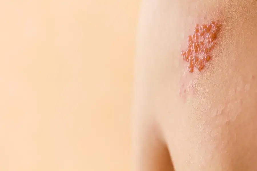 Biến chứng về da khá hiếm gặp