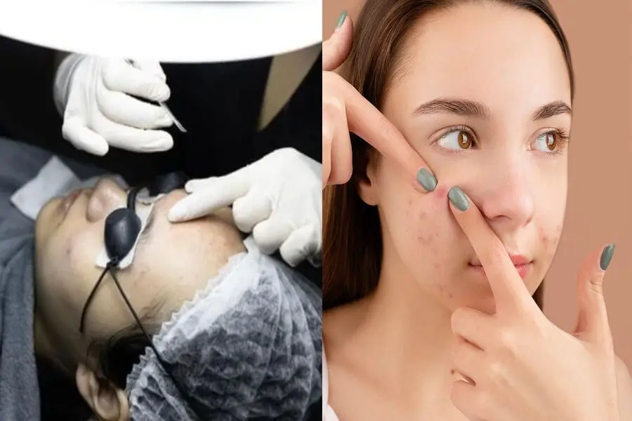 Sử dụng tay hoặc các dụng cụ chuyên dùng để nặn mụn đầu đen.