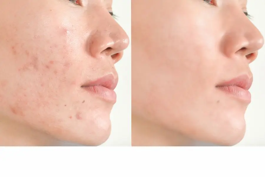 BHA giúp cải thiện hiện tượng mụn, thâm mụn