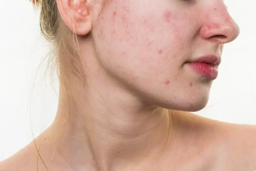 Mía giúp giảm các vấn đề về da