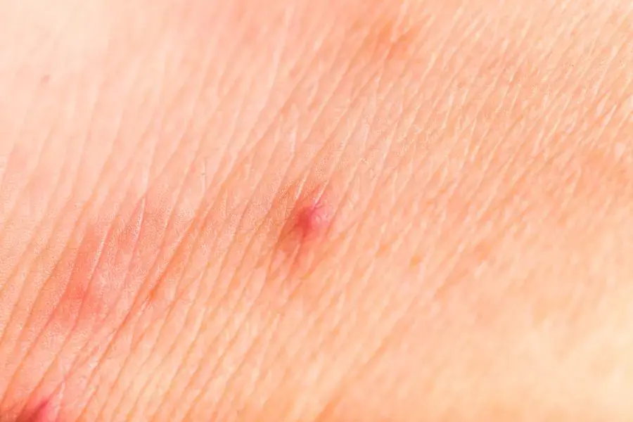 Đối với những người có làn da nhạy cảm, bọ chét cắn như một cơn ác mộng.