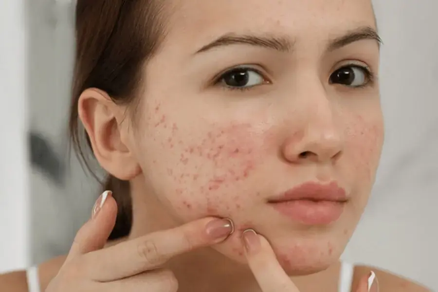Ăn quá nhiều bánh Nabati có thể gây mụn mặt.
