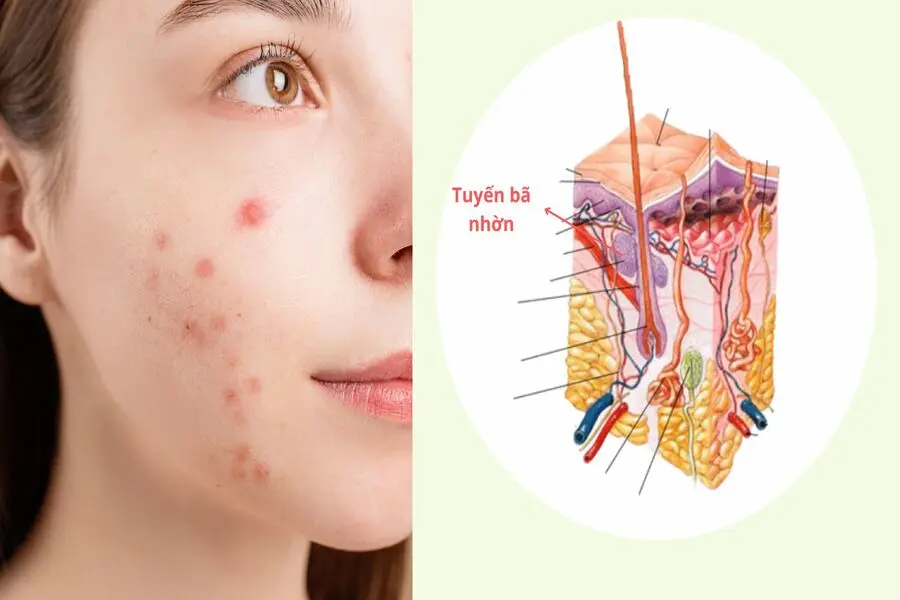 Tuyến bã nhờn trên da hoạt động mạnh có thể gây mụn.