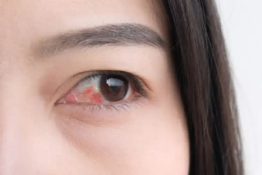 Vi khuẩn có hại xâm nhập gây bệnh ở mắt