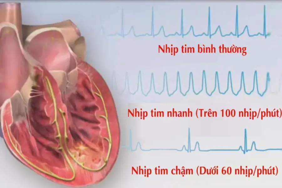 Thông qua nhịp đập để nhận biết nguy cơ bị rối loạn nhịp tim ở người già