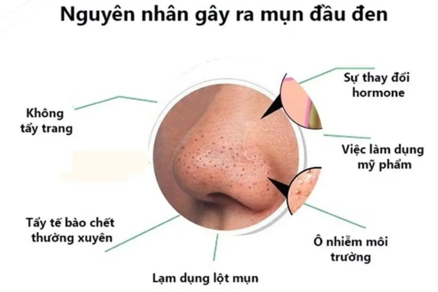 Có rất nhiều nguyên nhân gây ra mụn đầu đen.