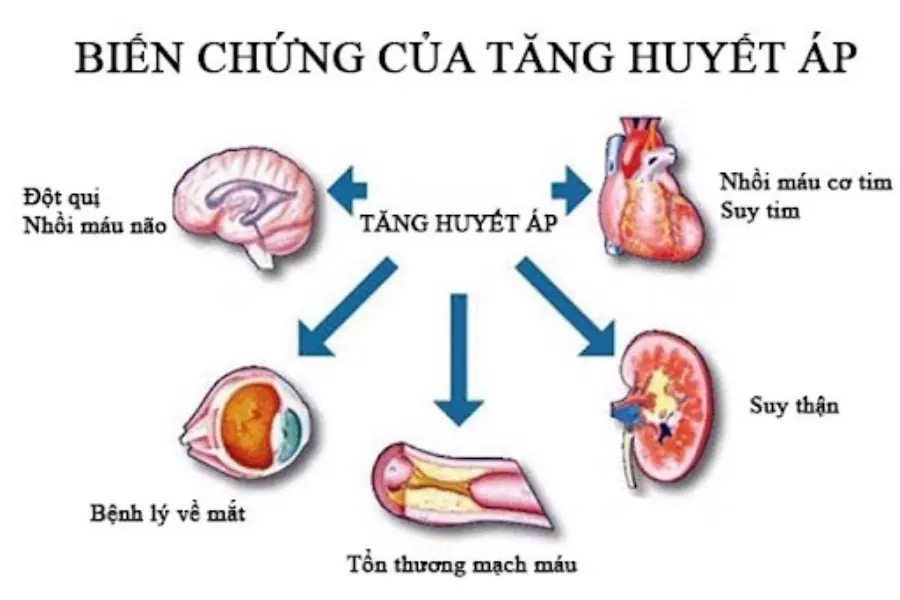 Các biến chứng do huyết áp cao gây nên: suy thận, bệnh về mắt,...