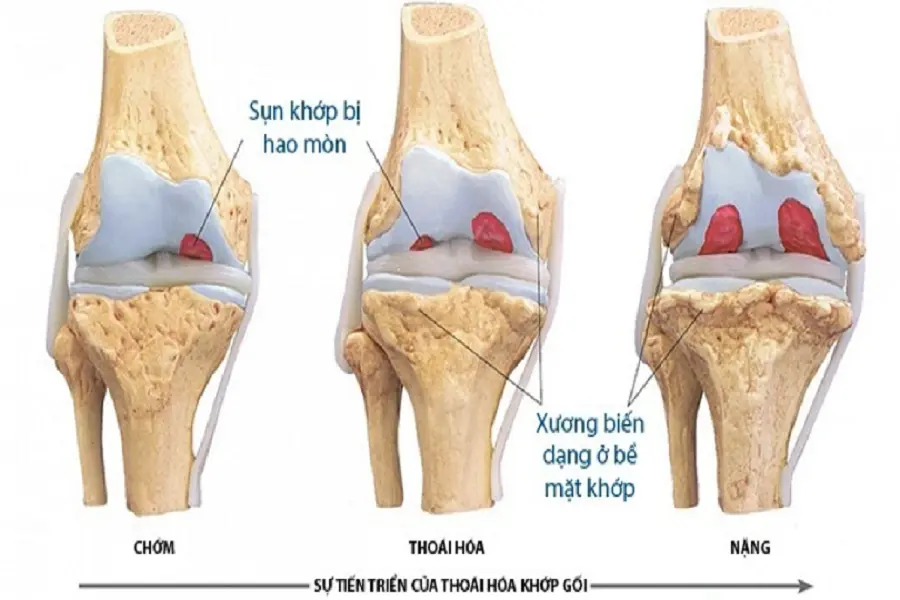 Sụn khớp bị bào mòn theo thời gian, xương tại bề mặt khớp bị biến dạng do cọ xát .