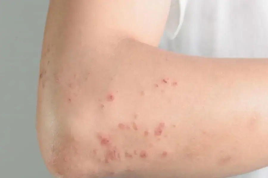 Vết cắn từ bọ chét có những đốm màu đỏ tạo hình vệt dài, gây ngứa ngáy khó chịu.