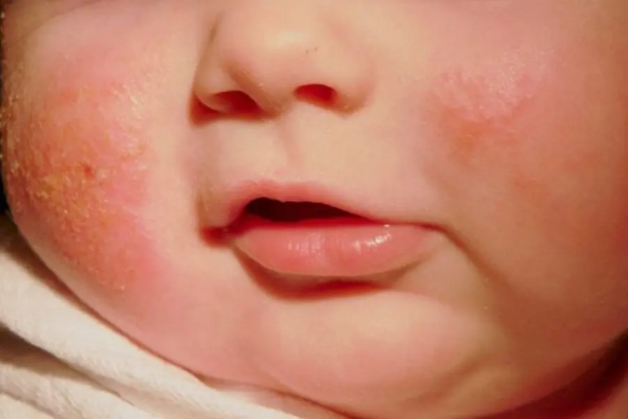 Mụn sữa ở trẻ sơ sinh