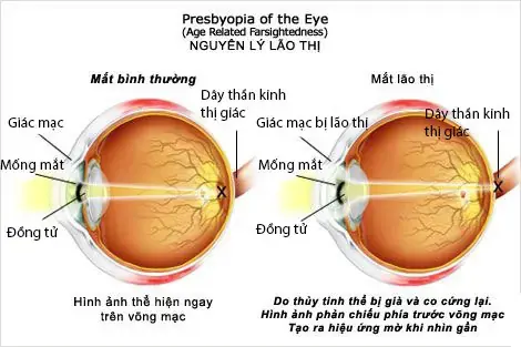 So sánh mắt bình thường và mắt lão thị