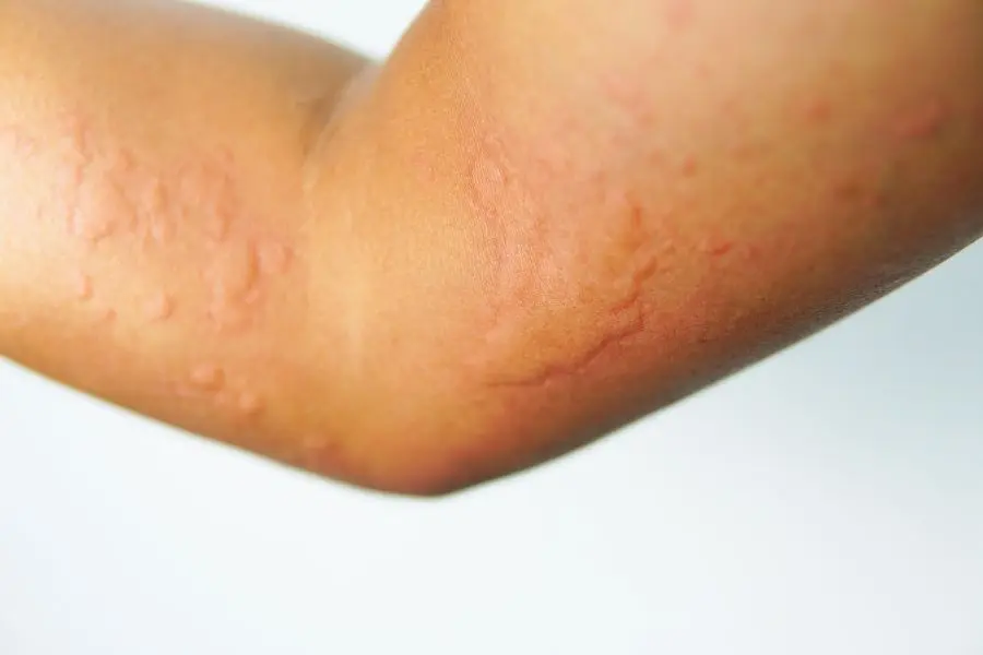 Da nhạy cảm bị ngứa khi thay đổi thời tiết.