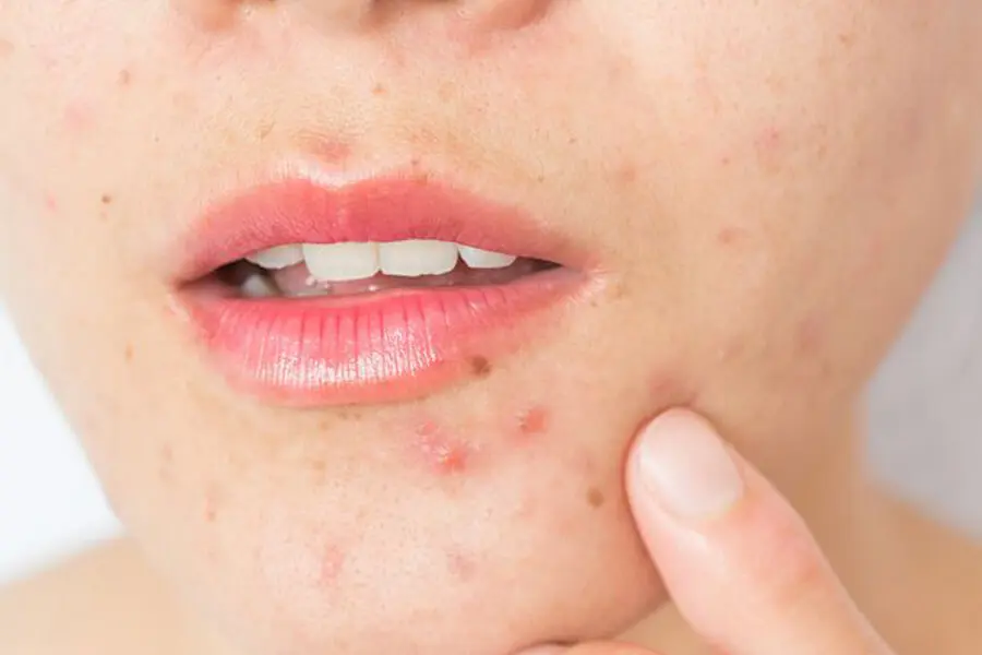 Không rửa mặt bằng nước vo gạo khi da đang bị tổn thương, kích ứng
