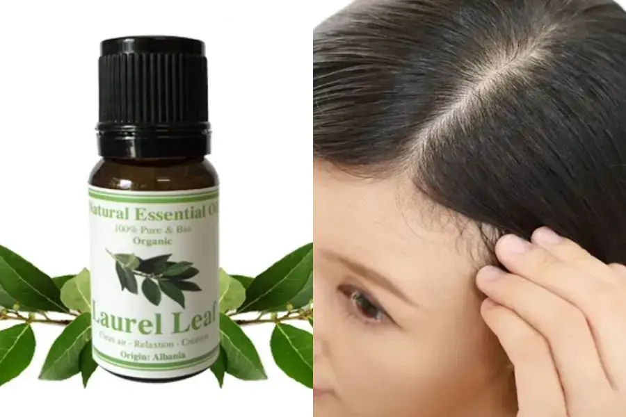 Gàu bị đánh bay hoàn toàn nhờ tinh dầu nguyệt quế.