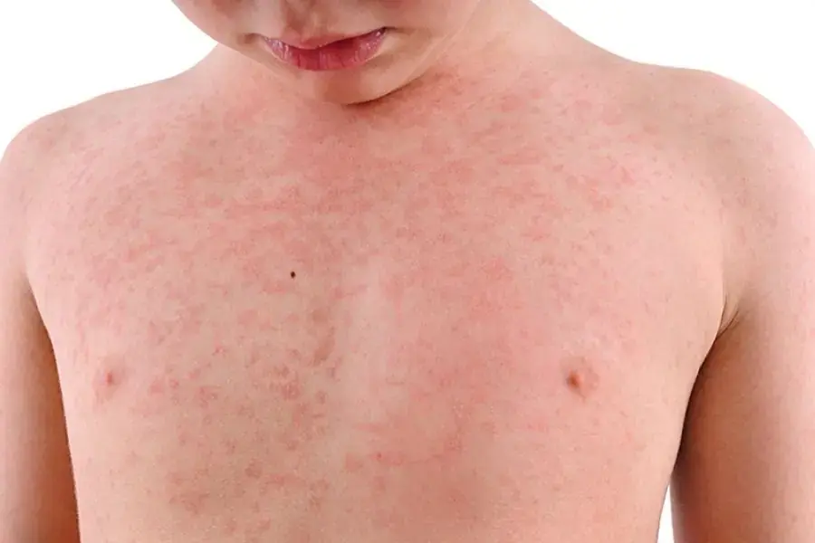 Xuất huyết dưới da ở trẻ em