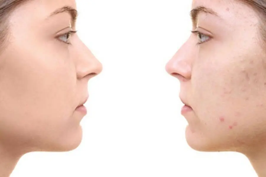 Giảm đáng kể thâm nám khi rửa mặt bằng nước vo gạo thường xuyên.