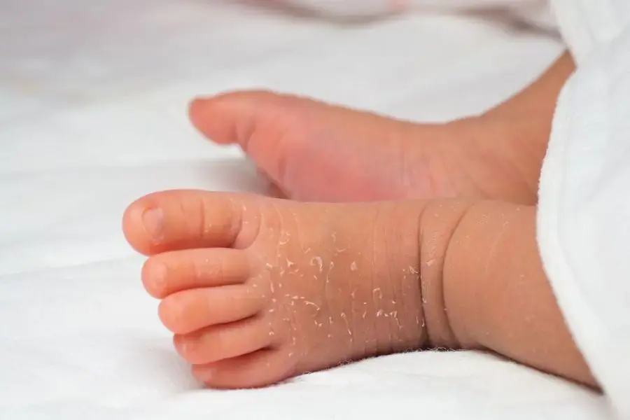 Nằm phòng điều hòa quá 4 giờ có thể khiến bé bị khô và bong tróc da