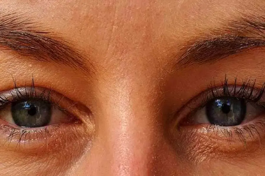 Khô mắt là tác hại của máy lạnh gây ra do thiếu ẩm (Hình ảnh: Medicalnewstoday)
