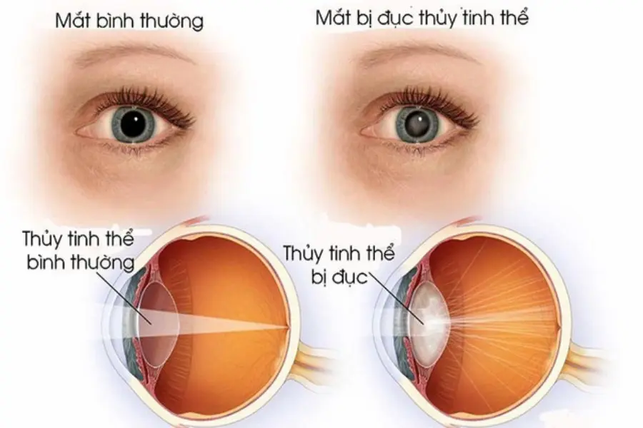 Mắt bình thường và mắt bị đục thuỷ tinh thể