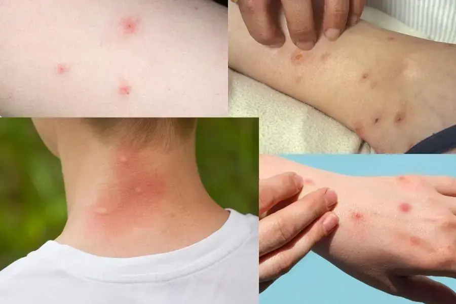 Những triệu chứng khi bị bọ chét cắn.