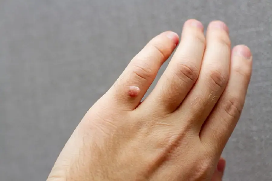 Mụn cóc là khối u nhỏ, sần sùi, tương đối lành tính nhưng gây mất thẩm mỹ cho da.