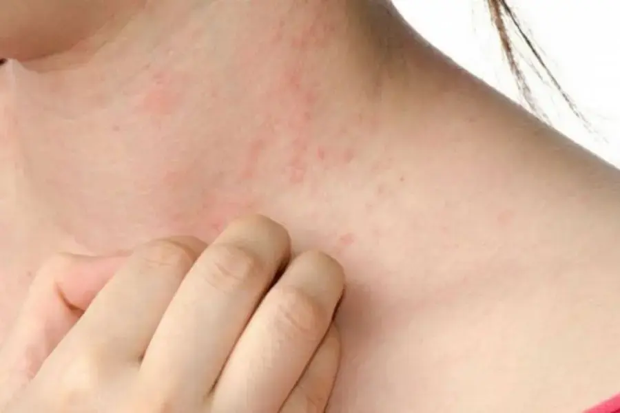 Cách điều trị tình trạng xuất huyết dưới da