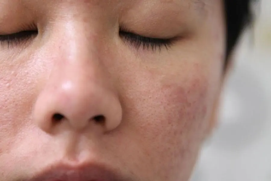 Các yếu tố bên ngoài và bên trong đều là những yếu tố khiến làm da bạn khô.