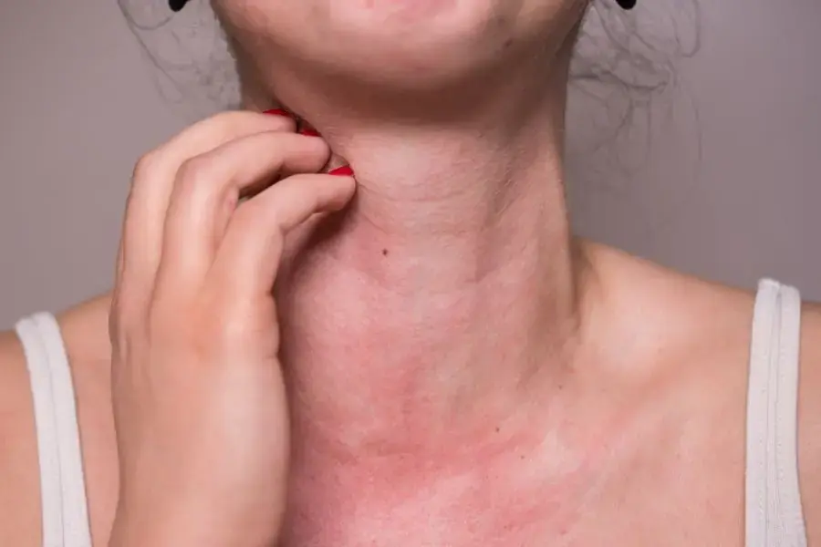 Bạn không nên ăn khoai mì nếu bị dị ứng