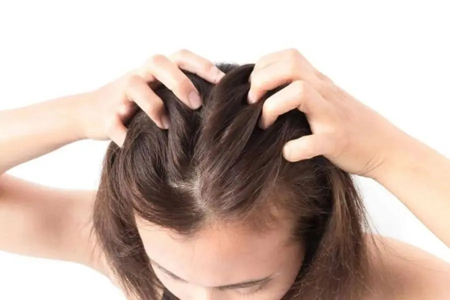 Trị chấy đúng cách để bảo vệ da đầu.