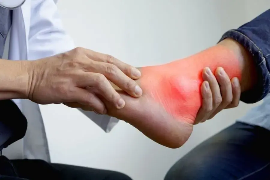 Uống cà phê đẩy lùi nguy cơ bệnh gout.