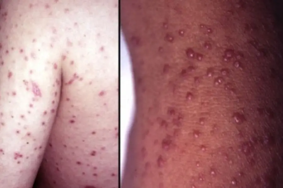 Nấm Histoplasma Capsulatum là tác nhân gây ra các bệnh liên quan đến cơ quan nội tạng ở người, đặc biệt là phổi