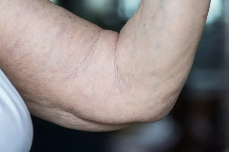 Thừa năng lượng dẫn đến tăng cân và mỡ bụng