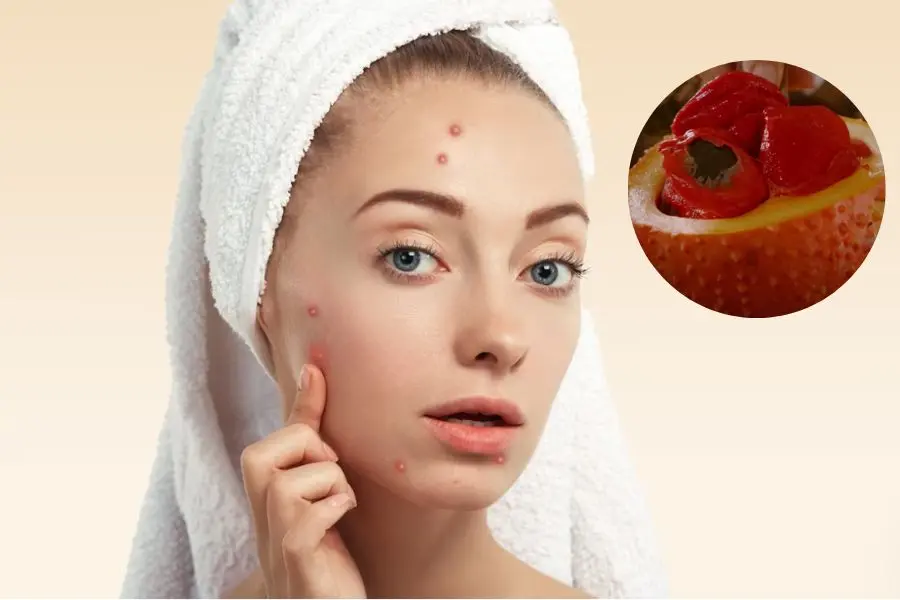 Hết mụn và tàn nhang với dầu gấc.