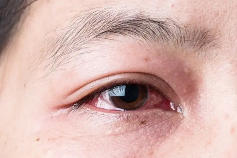 Những dấu hiệu ban đầu nhận biết bệnh đau mắt đỏ