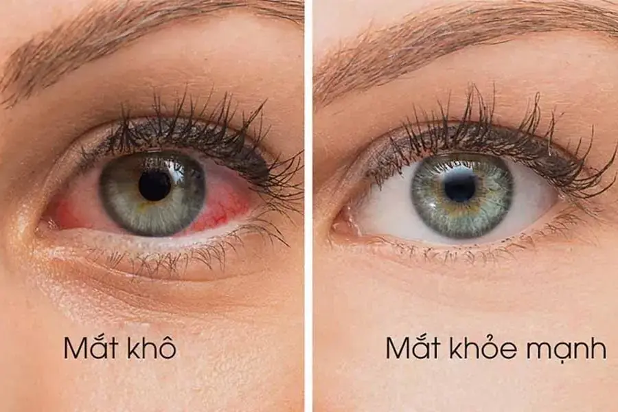 Mắt khô và mắt khỏe mạnh