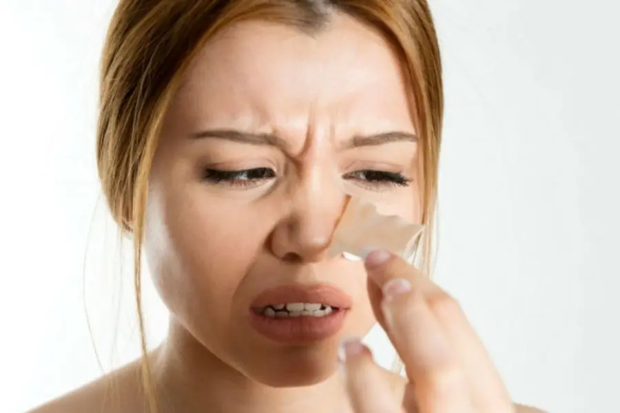 Tình trạng mụn đầu đen không còn xa lạ.