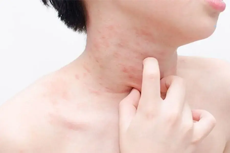 Nho khô có thể khiến cơ thể bị nóng trong, gây mụn phát ban.