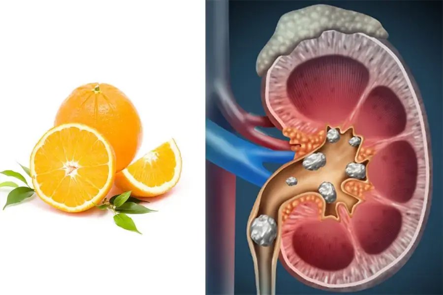 Trái cam hỗ trợ trong quá trình điều trị sỏi thận và bệnh gout