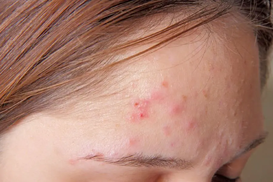 Rửa mặt bằng nước muối thường xuyên giúp ngăn ngừa mụn trứng cá phát triển.