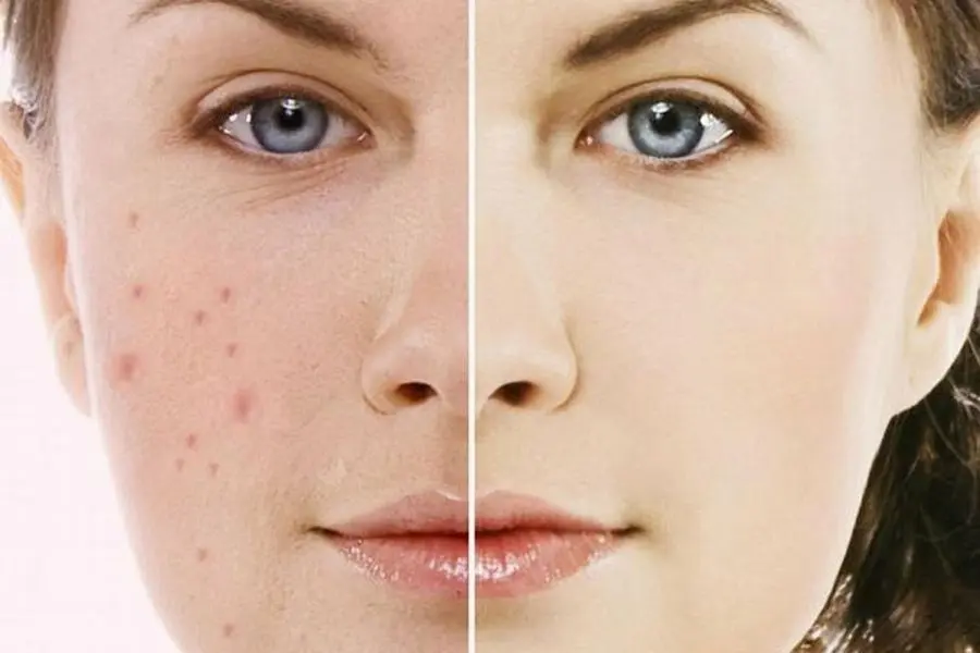 Bước tiếp theo là bạn nên dùng kem trị mụn, hoặc các sản phẩm đặc trị nám, tàn nhang, sẹo thâm.