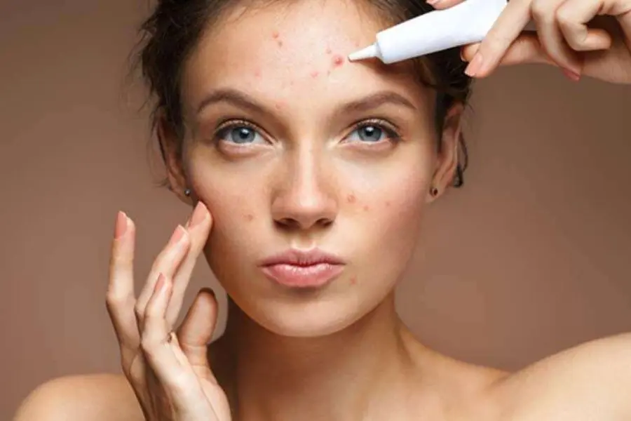 Tình trạng đẩy mụn khi sử dụng retinol.