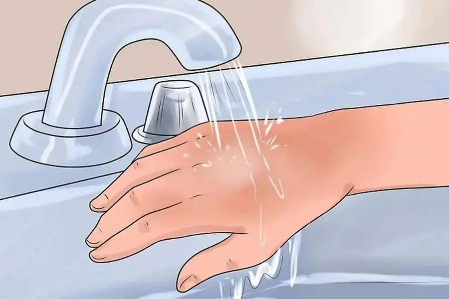 Rửa vết bỏng dưới vòi nước lạnh (1)