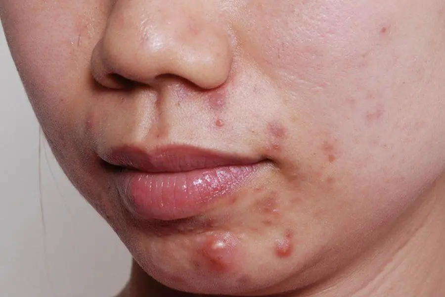 Dấu hiệu nhận biết mụn bọc là nốt mụn sưng đỏ, đường kinh mụn lớn và gây đau vùng da xung quanh.