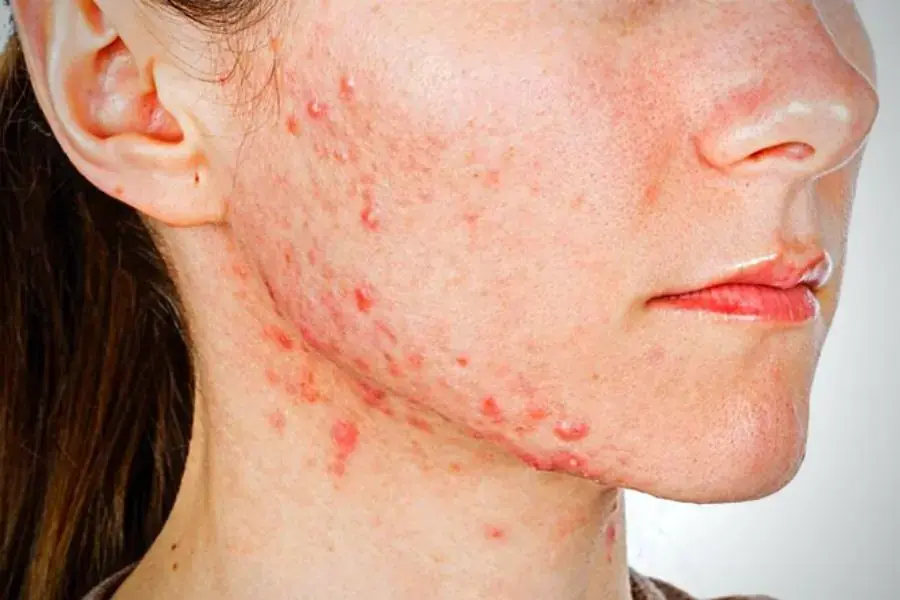 Ăn quá nhiều bánh tiêu có thể gây mụn mặt.
