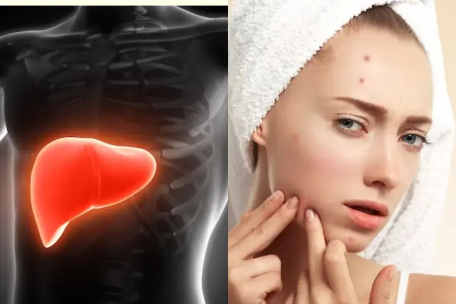 Nóng gan là nguyên nhân gây nên mụn nhọt trên cơ thể.