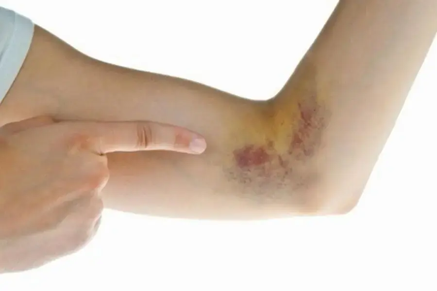 Xuất huyết dưới da ở người cao tuổi