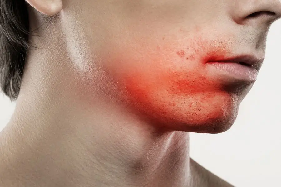 Da nhạy cảm là làn da dễ bị phát ban.