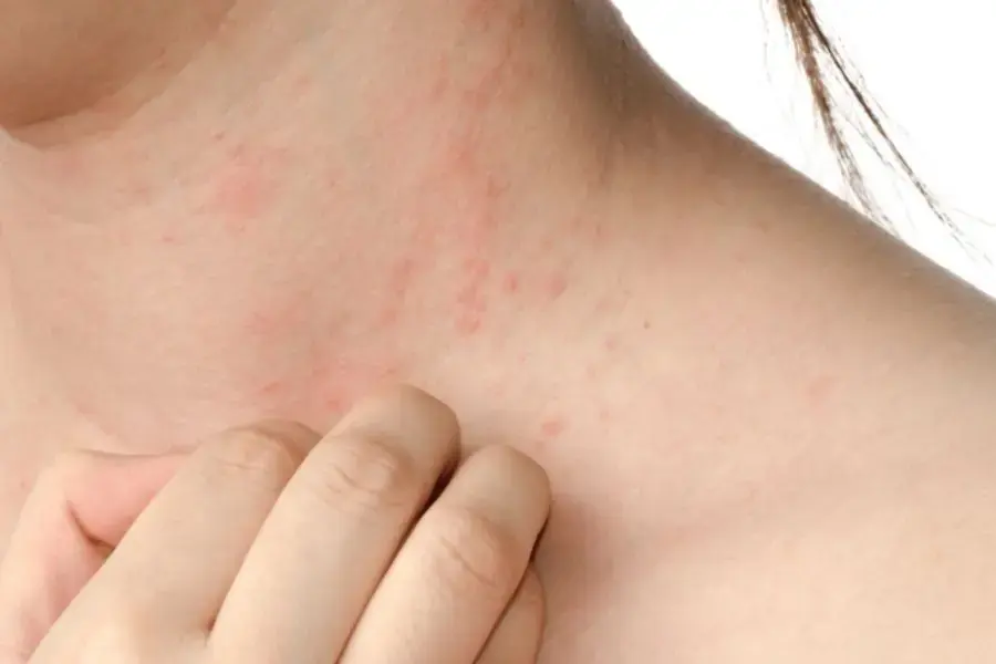 Vết cắn của bọ chét thường có hình dạng những đốm nhỏ hoặc vệt màu đỏ dài.