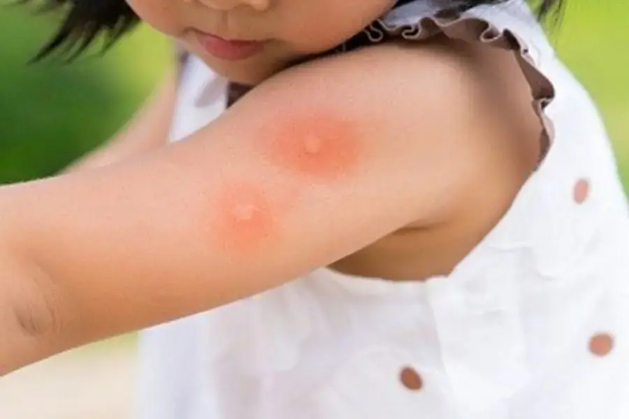 Dịu da, giảm sưng đỏ các vết do côn trùng cắn